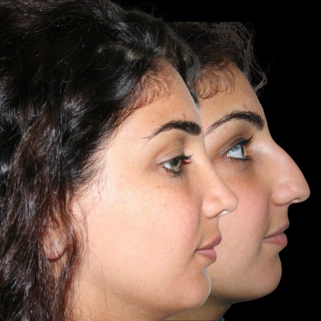 Rhinoplasty Before And After Photos Forbest Clinic