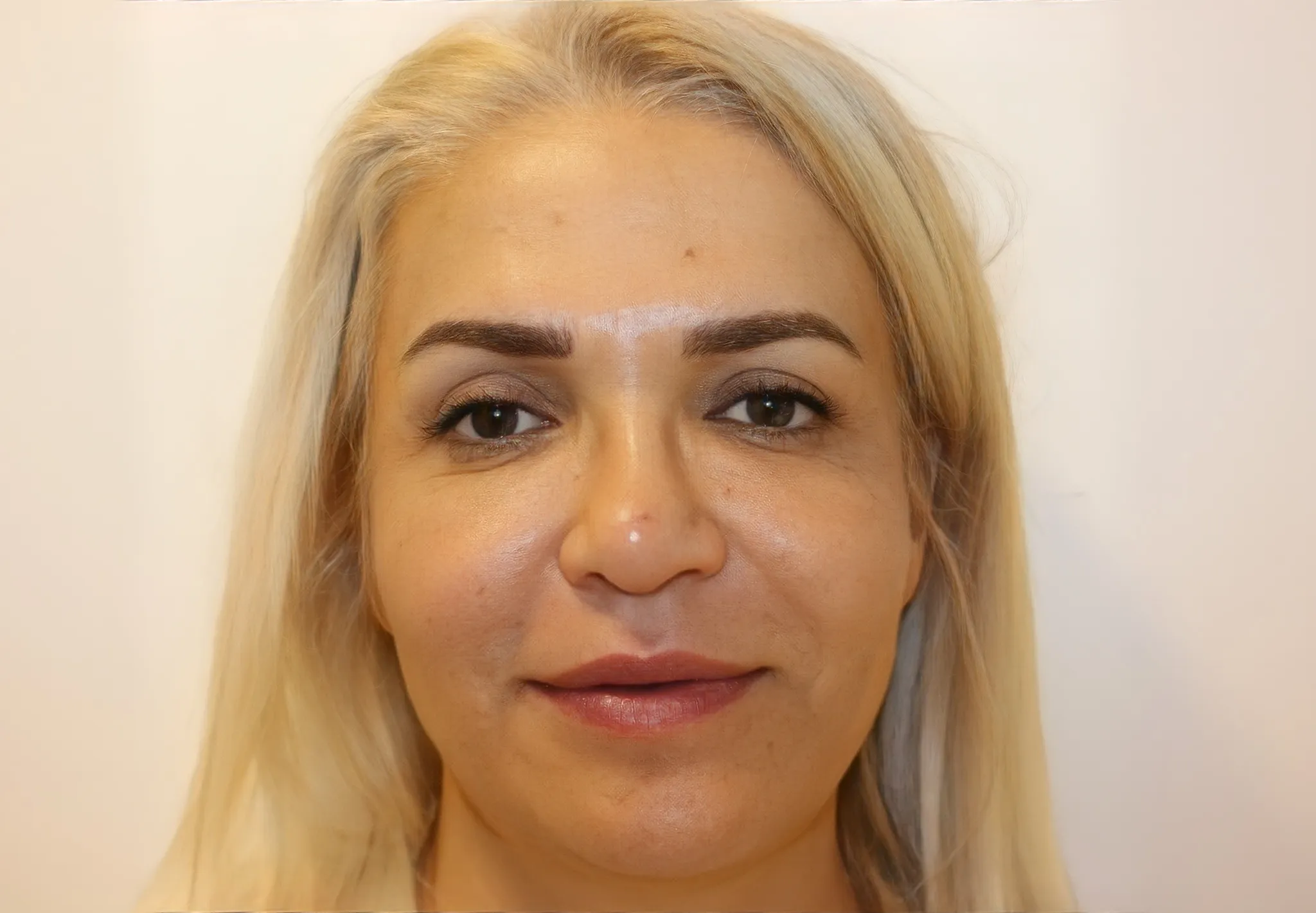 Eyelid Surgery Before And After Photos Forbest Clinic